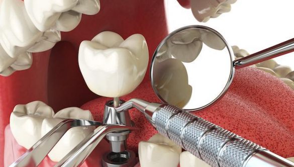 Zambet impecabil cu ajutorului implantului dentar