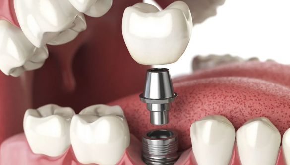 Ce este implantul dentar?