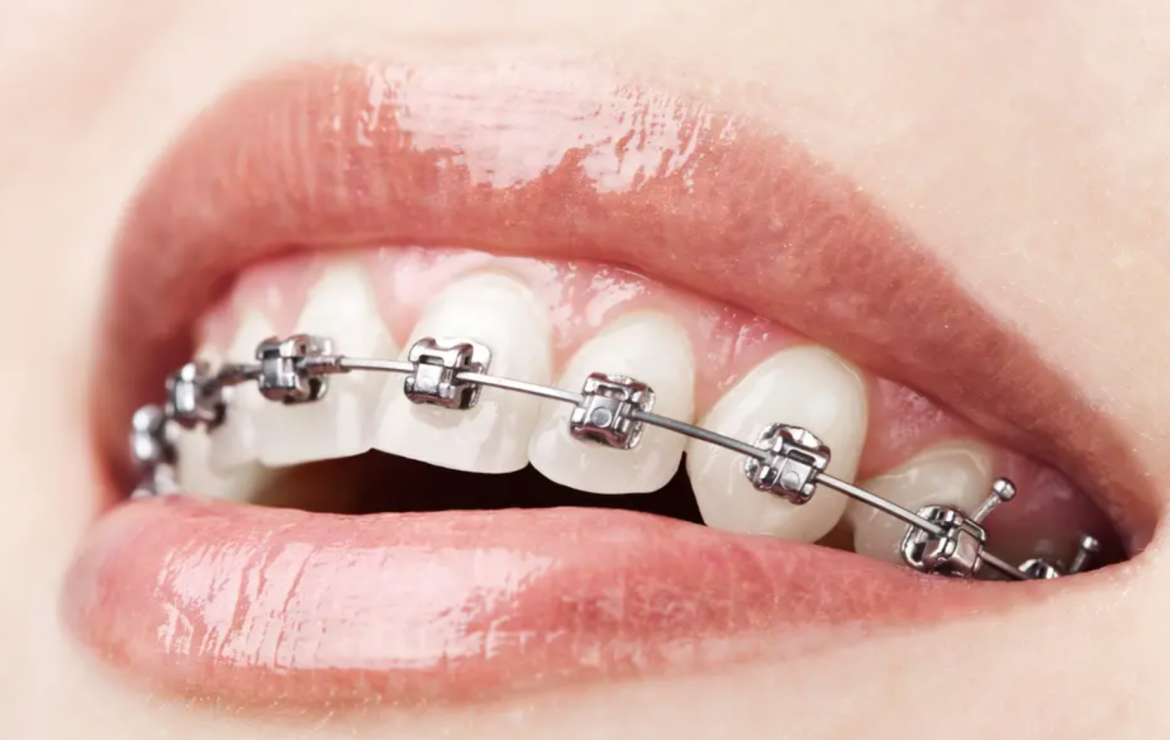 Ce trebuie sa stii despre tratamentul ortodontic la adulti ?
